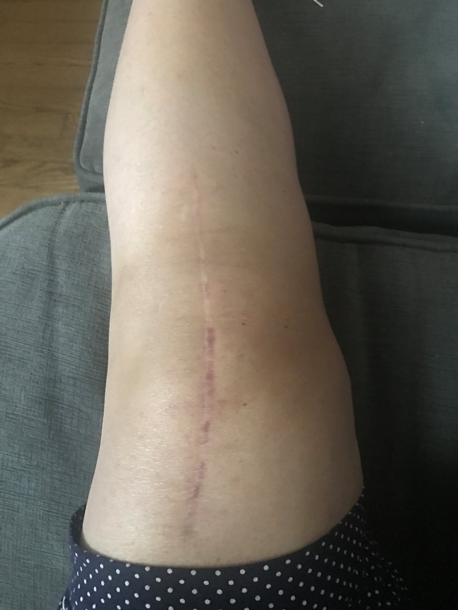 How Long For Scar To Heal After Knee Replacement